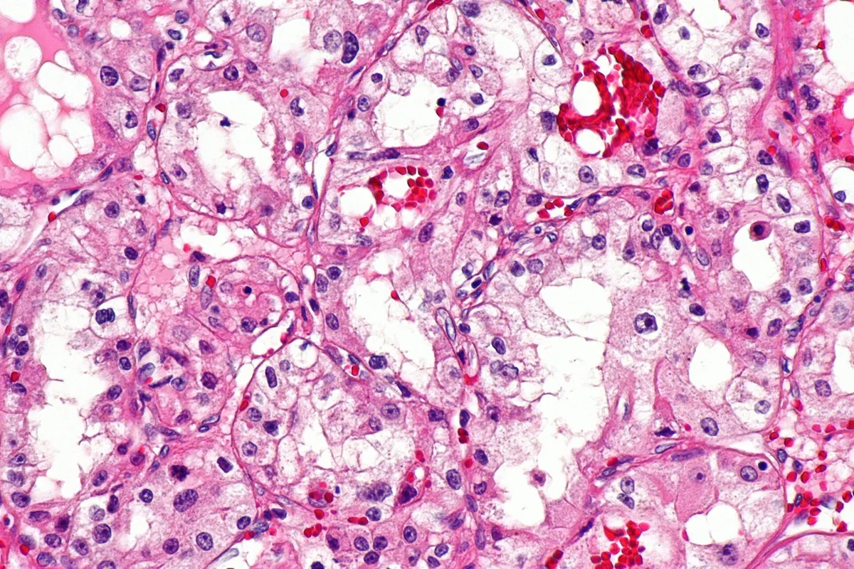 cancer cell microscope