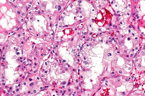Athira Pharma Shifts Focus to Oncology with Promising Breast Cancer Drug and Major Financing Boost
